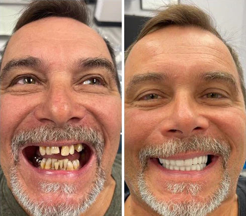SmileShade – Versteckt schnell Zahnfehler für ein makelloses Lächeln