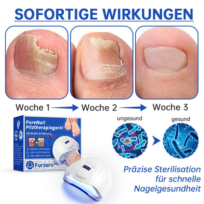PureNail™ | Laser therapy device for nail fungus