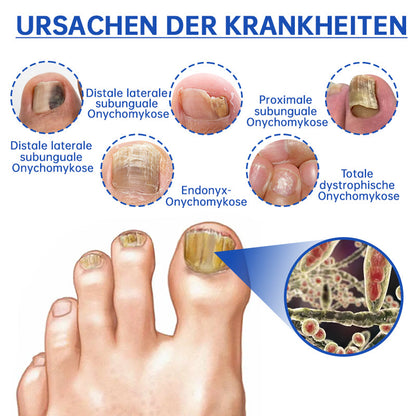 PureNail™ | Laser therapy device for nail fungus