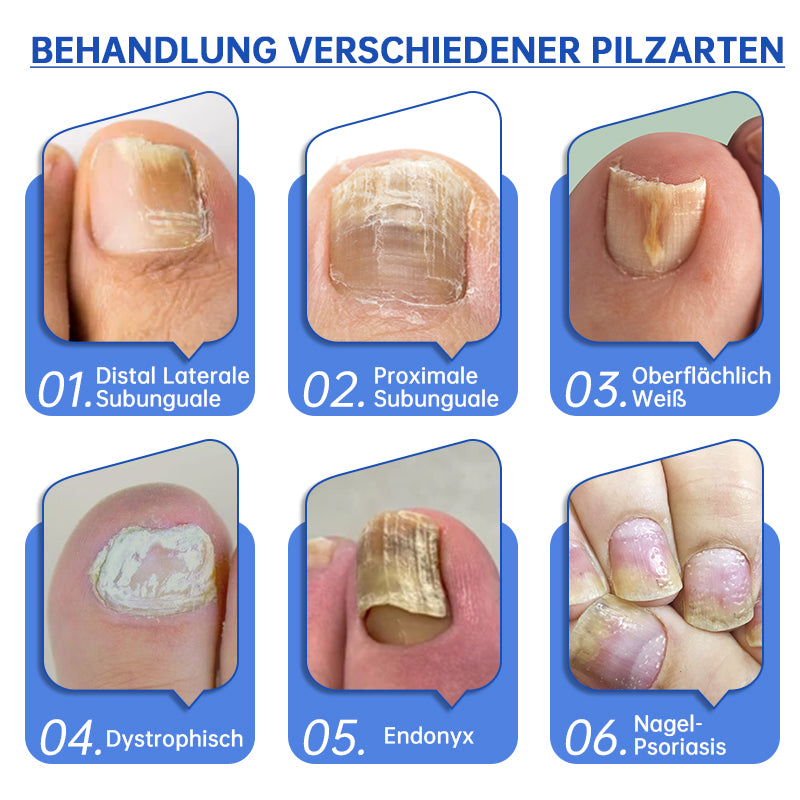 PureNail™ | Laser therapy device for nail fungus