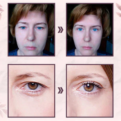 MagicLift™ | Eyelid Lift