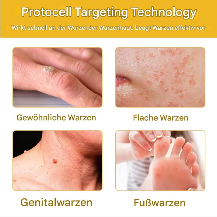 TagAway – Effektive Entfernung von Warzen und Hautwucherungen