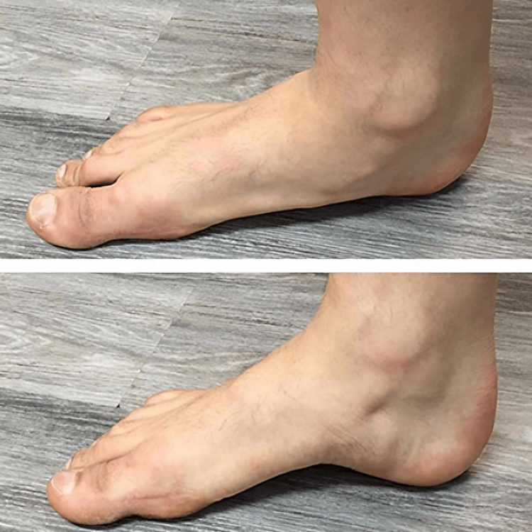 StepRelief™ | Orthopedic Arch Support [1+1 Free] 